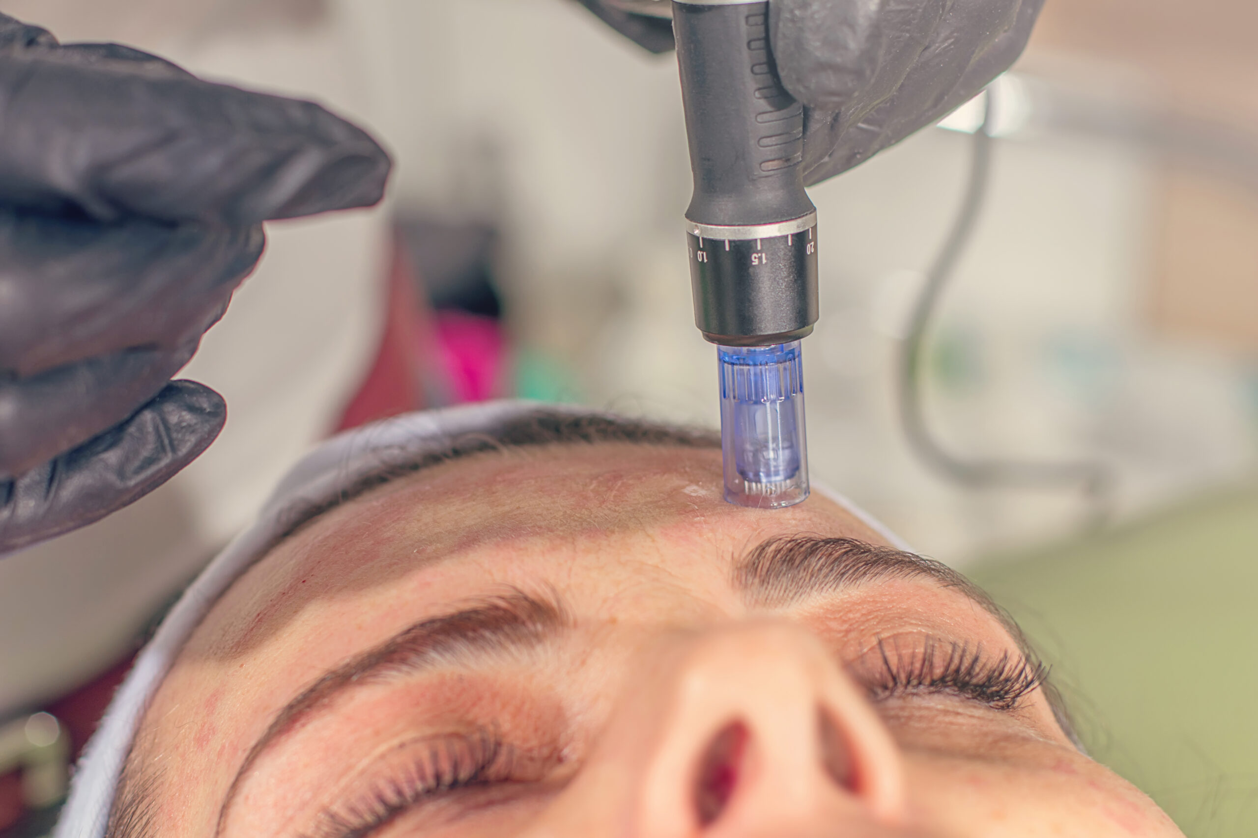 Microneedling on a woman's face